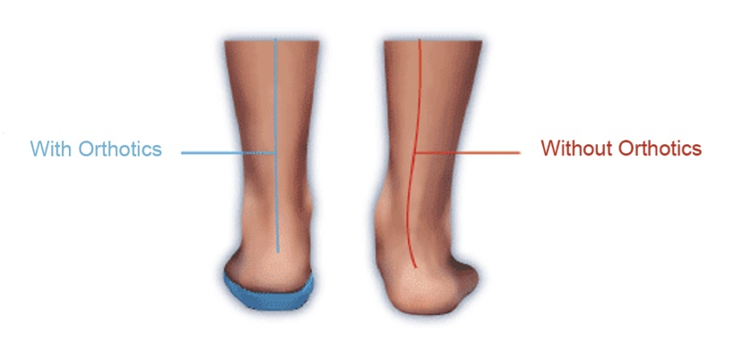 Orthotics1