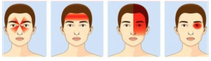 types of headaches